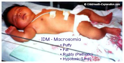 macrosomia large for gestational age baby blood sugar levels chart by age