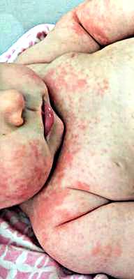  Vaccine Allergy or Infantile Eczema?