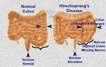 Hirschsprung's Disease: Inborn Paucity of Nerves in Gastrointestinal Tract