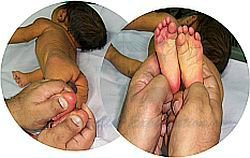 How Parents Can Detect Jaundice Newborn?
