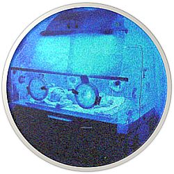 Phototherapy for Jaundice in Newborns
