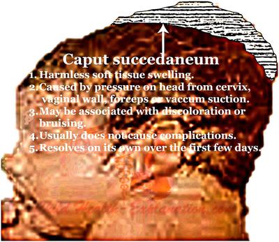 Caput Succedaneum