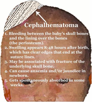 Cephalhematoma