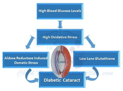 Development of Diabetic Cataract