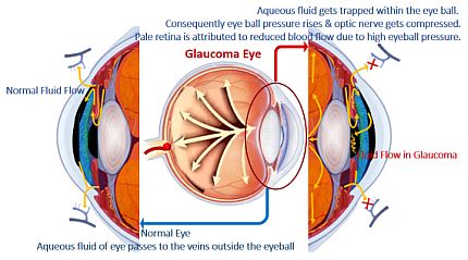 Development of Glaucoma Eye